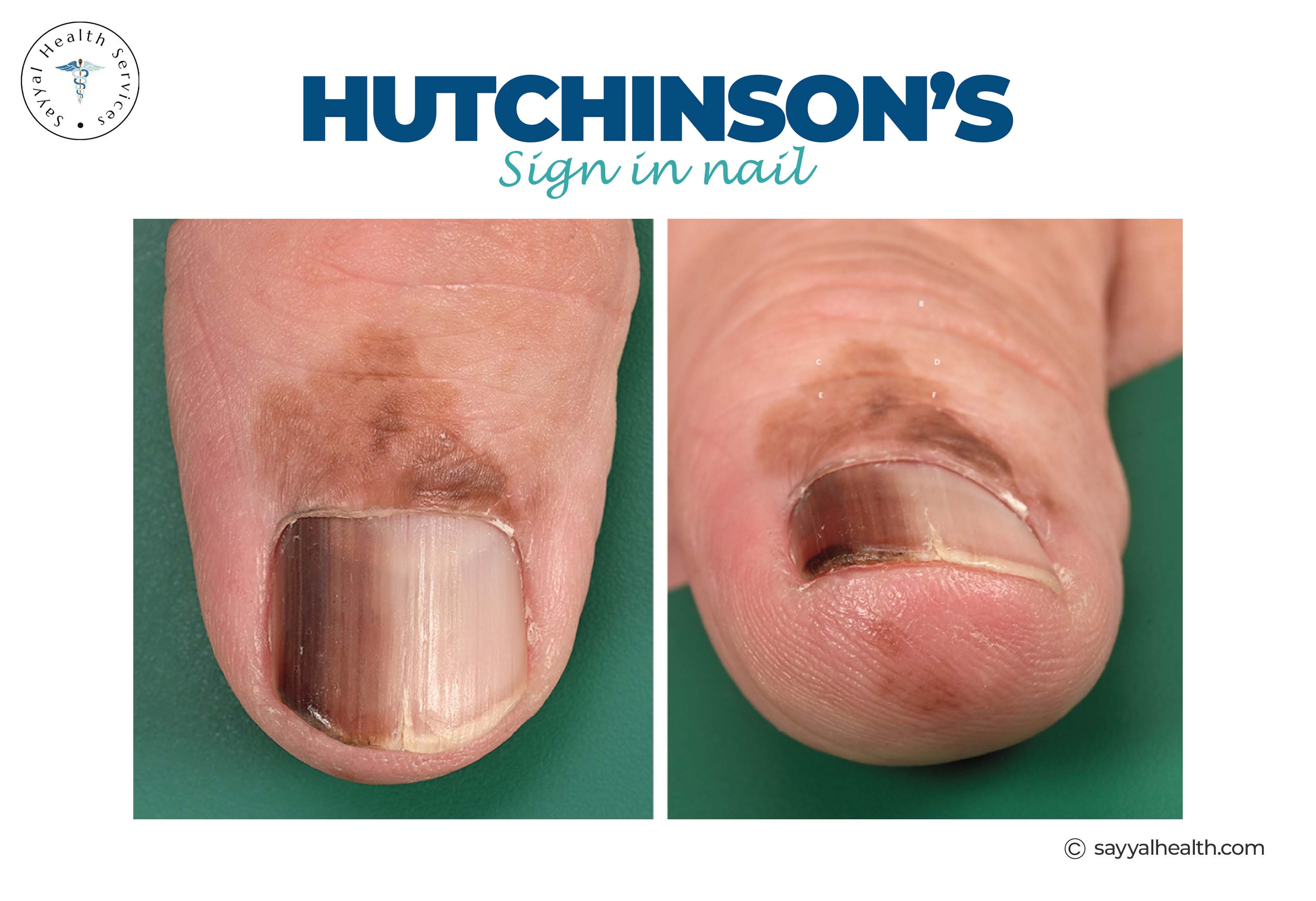 Hutchinson's sign in nail melanoma showing pigmentation spreading to nail fold